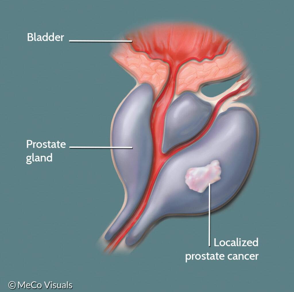 localized prostate cancer)