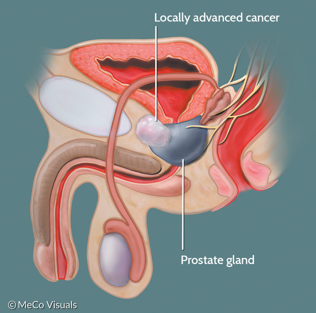 prostatitis típusok és kezelés