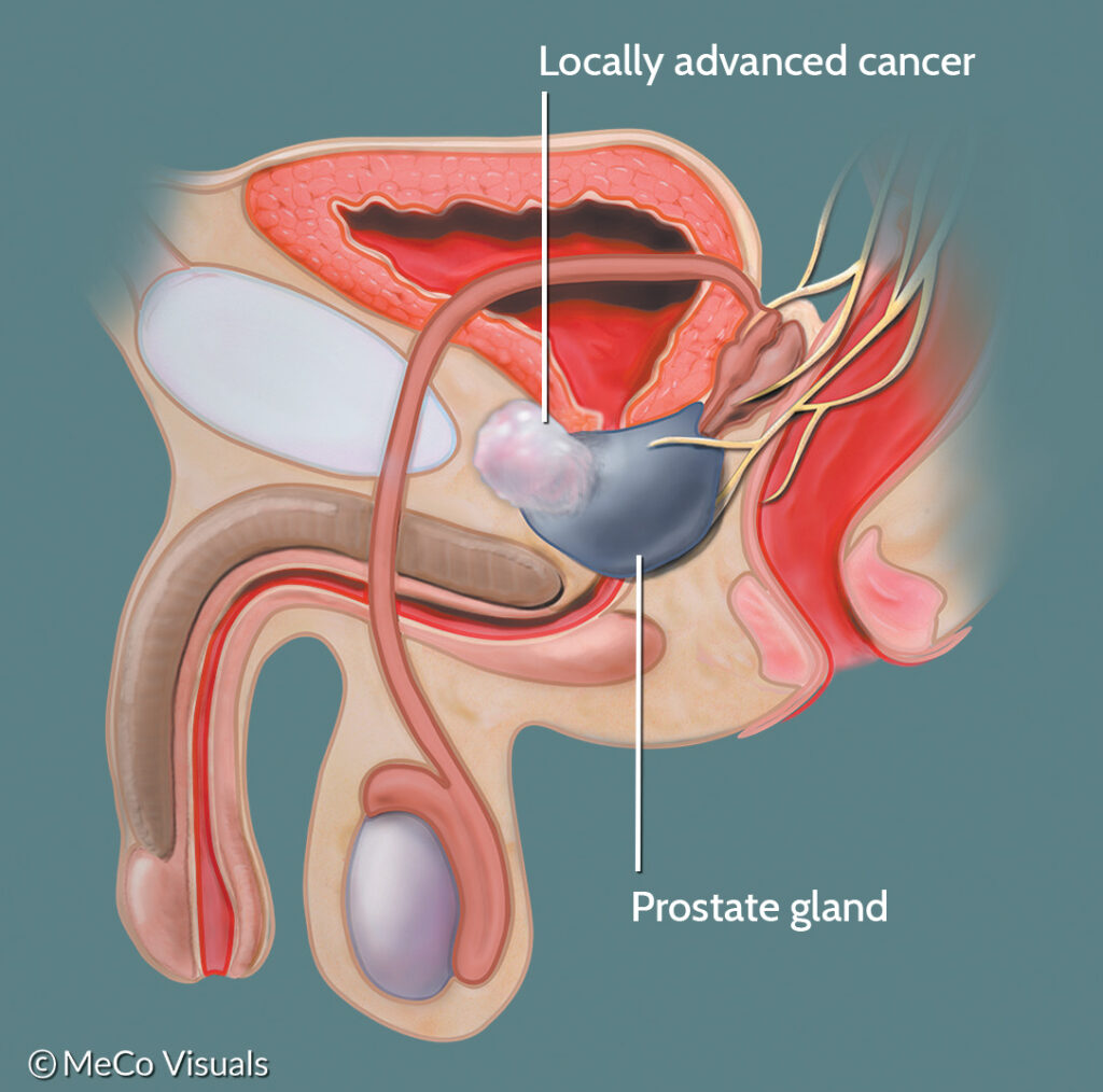 types of prostate surgery