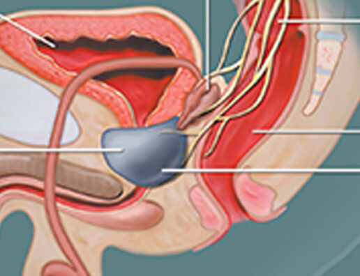 chabret és prostatitis