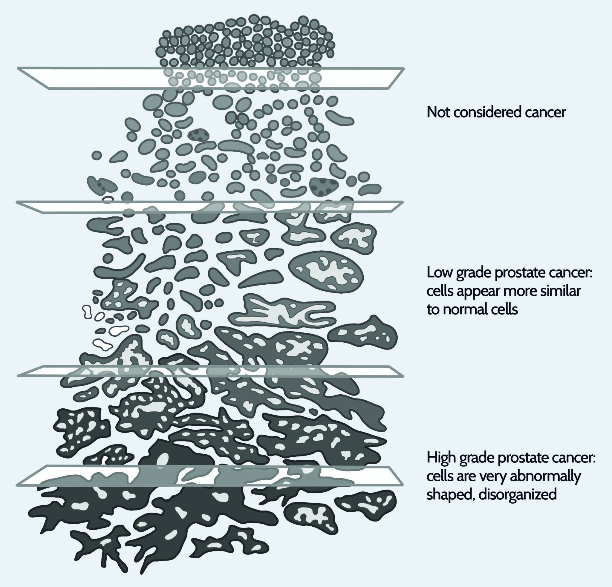 What is a Gleason Score? | Prostate Cancer Foundation