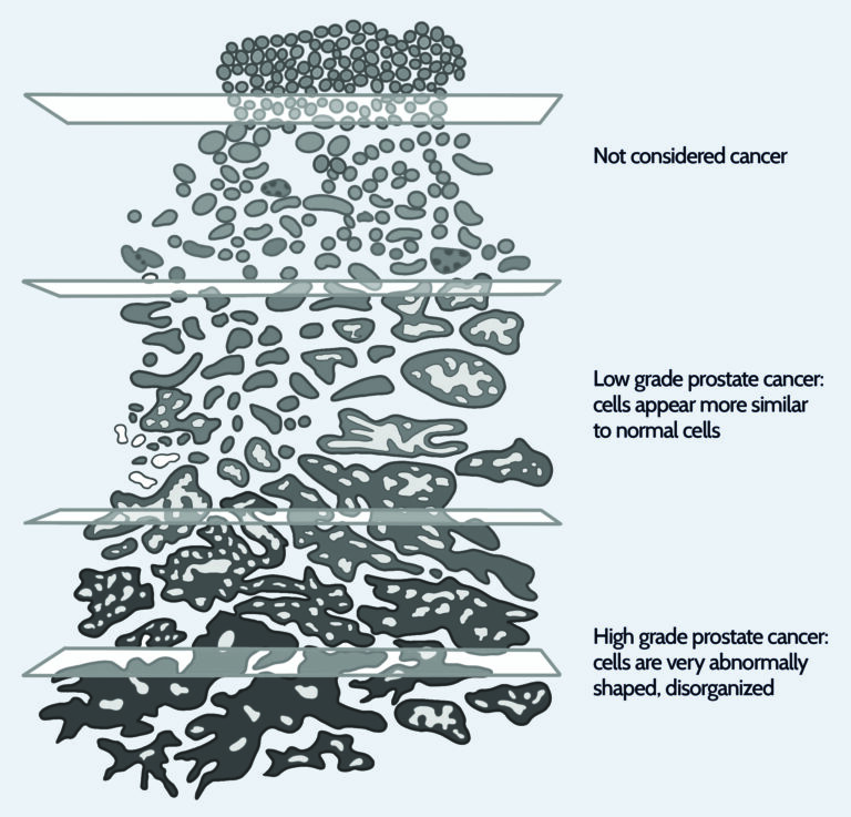 What is a Gleason Score? | Prostate Cancer Foundation