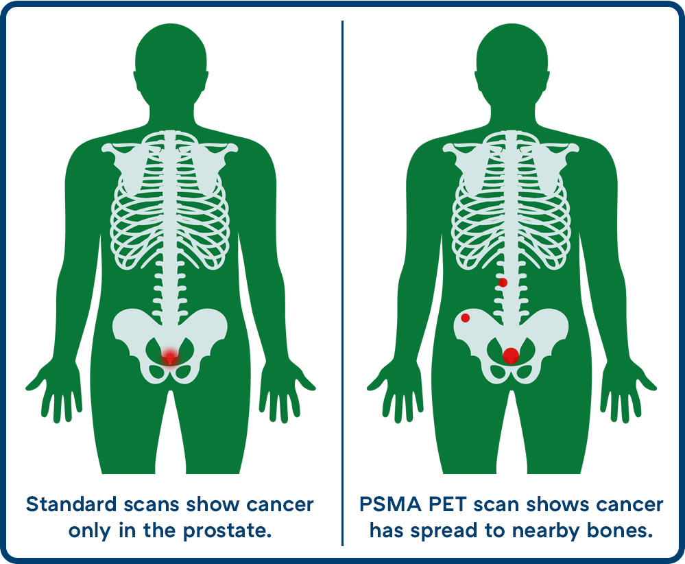 side by side skeletons showing standard scans vs. PSMA PET scan with cancer spreading to nearby bones
