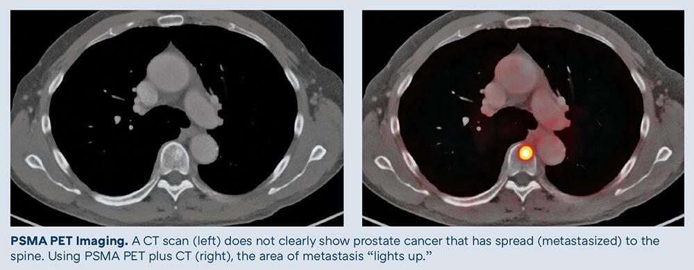 PSMA PET Imaging scan comparing a CT scan vs. PSMA PET plus CT showing the spread of prostate cancer